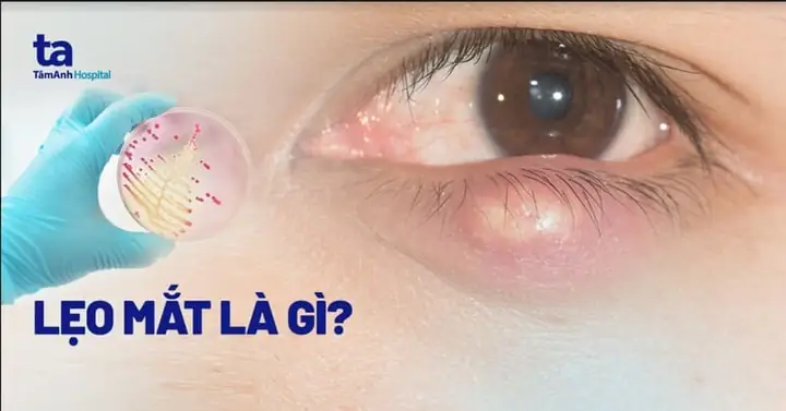 Trẻ Bị Mụt Lẹo Phải Làm Sao