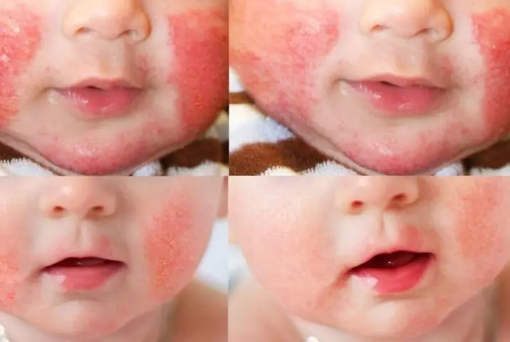 Trẻ Bị Nổi Mẩn Đỏ Trên Mặt