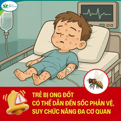 Trẻ Bị Ong Đốt Phát Sốt Trẻ Bị Ong Đốt Phát Sốt