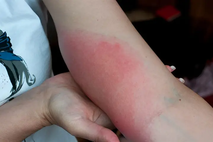 Trẻ Bị Ong Đốt Phát Sốt Trẻ Bị Ong Đốt Phát Sốt