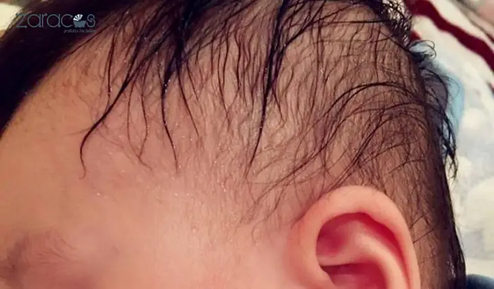 Trẻ Bị Ra Mồ Hôi Trộm