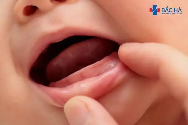 Trẻ Bị Viêm Lợi Khi Mọc Răng