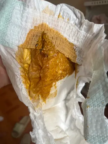 Trẻ Đi Ngoài Nhiều Lần Ra Máu Nhầy