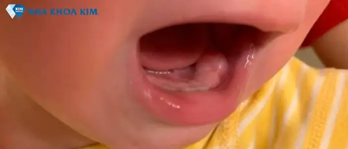 Trẻ Mọc Răng Bị Viêm Lợi