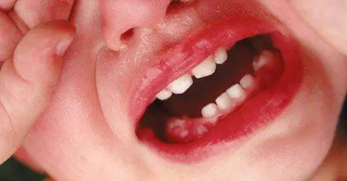 Trẻ Mọc Răng Bị Viêm Lợi