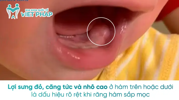 Trẻ Mọc Răng Bị Viêm Lợi