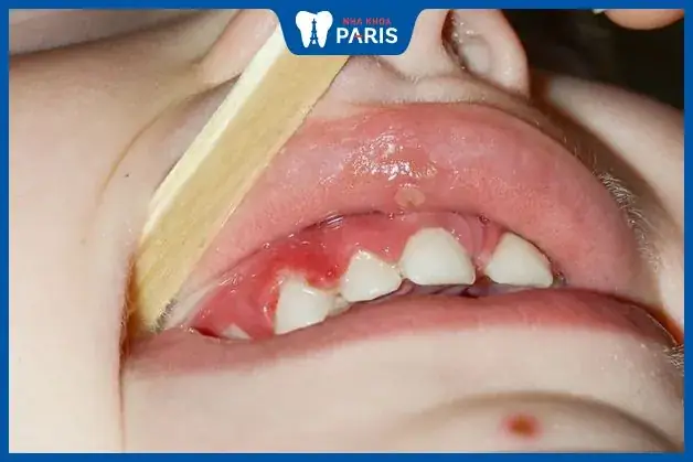 Trẻ Mọc Răng Bị Viêm Lợi