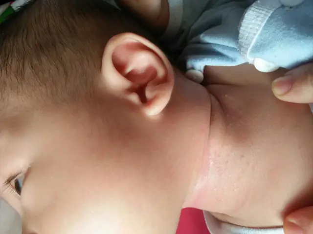 Trẻ Sơ Sinh Bị Hăm Ở Cổ Phải Làm Sao