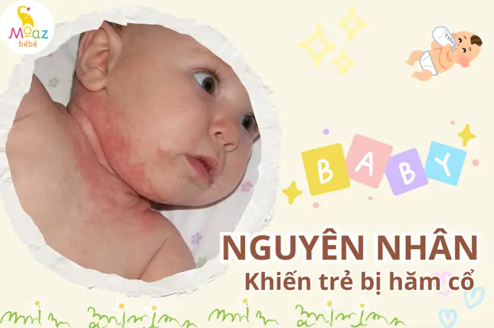 Trẻ Sơ Sinh Bị Hăm Ở Cổ Phải Làm Sao
