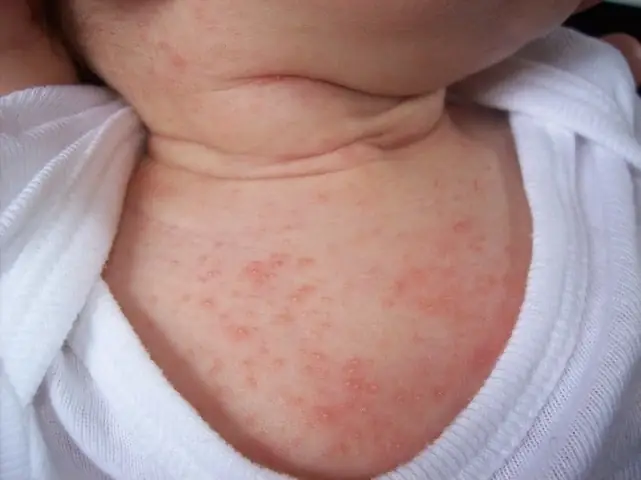 Trẻ Sơ Sinh Bị Hăm Ở Cổ Phải Làm Sao