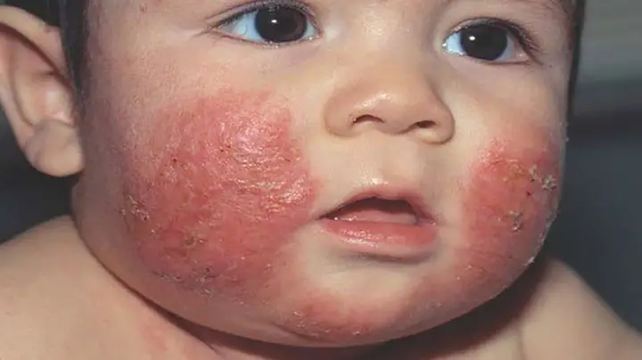 Trẻ Sơ Sinh Bị Khô Da Mặt Và Mẩn Đỏ