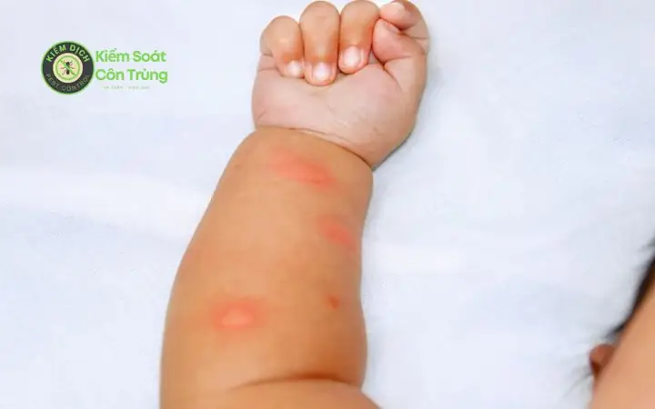 Trẻ Sơ Sinh Bị Muỗi Cắn Trẻ Sơ Sinh Bị Muỗi Cắn