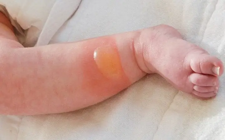 Trẻ Sơ Sinh Bị Muỗi Cắn Trẻ Sơ Sinh Bị Muỗi Cắn