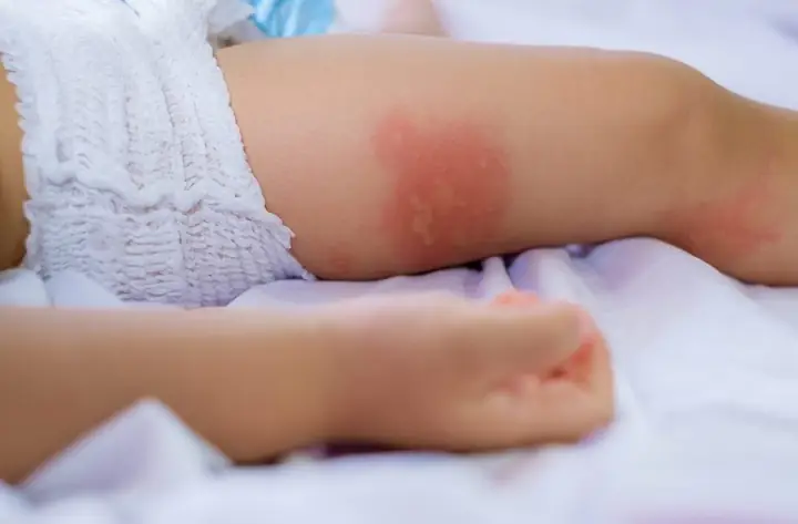 Trẻ Sơ Sinh Bị Muỗi Cắn Trẻ Sơ Sinh Bị Muỗi Cắn