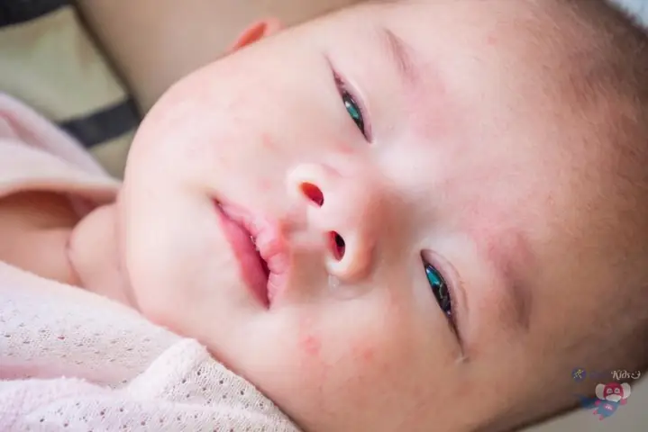 Trẻ Sơ Sinh Mọc Mụn Nước