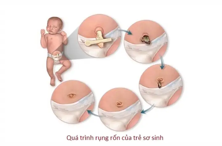 Trẻ Sơ Sinh Rụng Rốn Bao Lâu Thì Lành