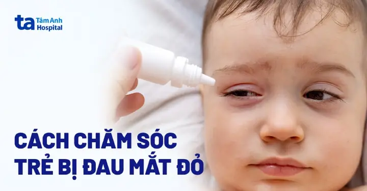 Trị Đau Mắt Đỏ Cho Trẻ Sơ Sinh