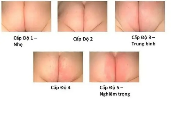 Trị Hăm Cho Trẻ Sơ Sinh Tại Nhà Trị Hăm Cho Trẻ Sơ Sinh Tại Nhà
