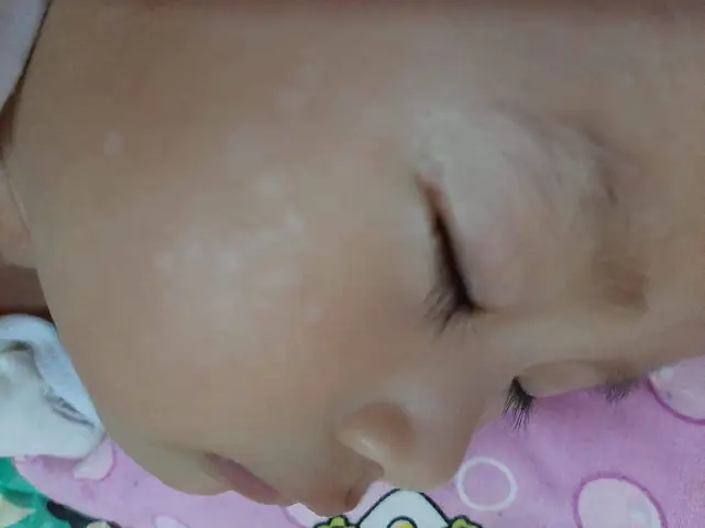 Trị Lang Beng Ở Mặt Cho Trẻ Sơ Sinh