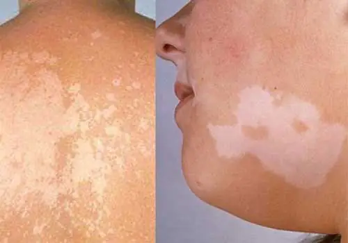 Trị Lang Beng Ở Mặt Cho Trẻ Sơ Sinh