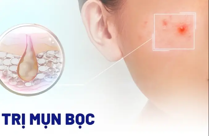 Trị Mụn Bọc Cho Da Dầu