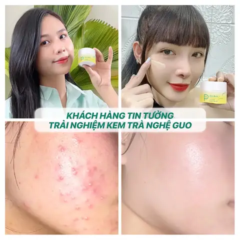 Trị Mụn Thâm Cho Bà Bầu