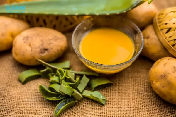 Trị Mụn Trứng Cá Bằng Khoai Tây