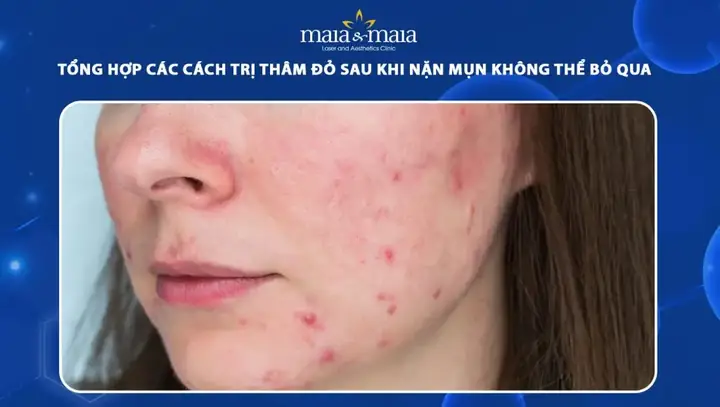 Trị Thâm Đỏ Sau Nặn Mụn Trị Thâm Đỏ Sau Nặn Mụn