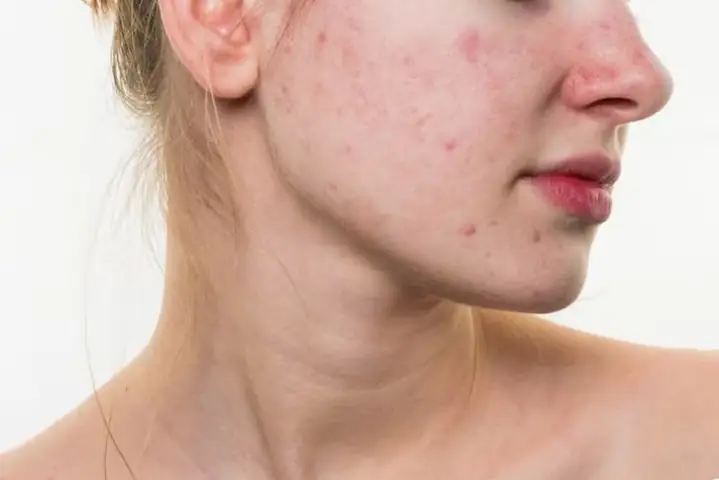 Trị Thâm Đỏ Sau Nặn Mụn