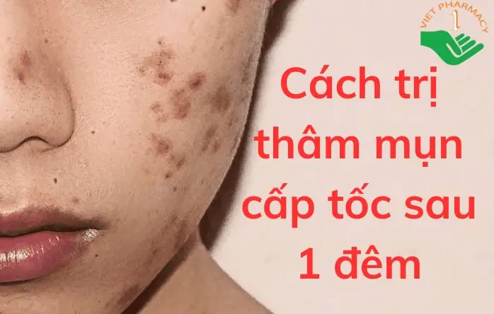 Trị Thâm Sau Mụn Tại Nhà