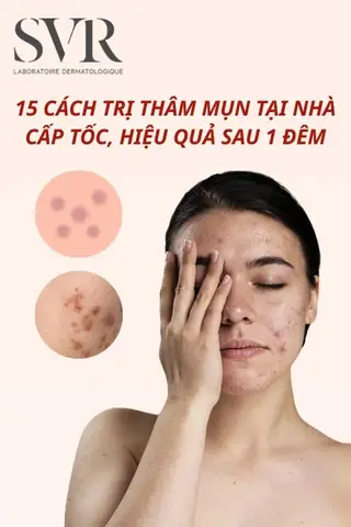 Trị Thâm Sau Mụn Tại Nhà