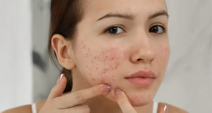 Trị Thâm Sau Mụn Tại Nhà