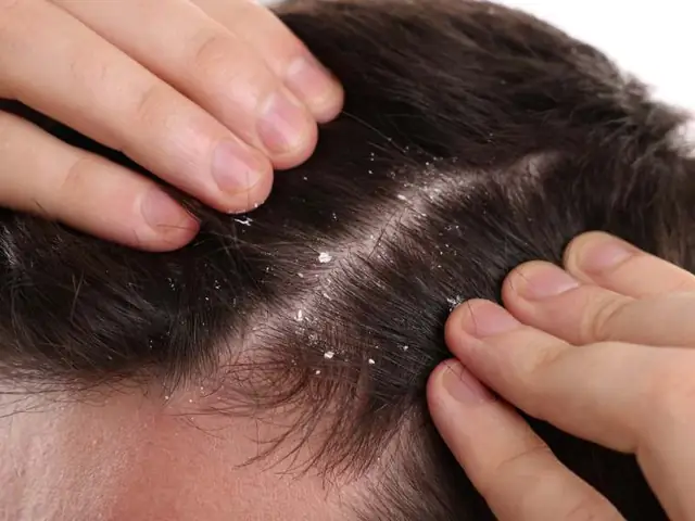 Vừa Gội Đầu Xong Da Có Gàu