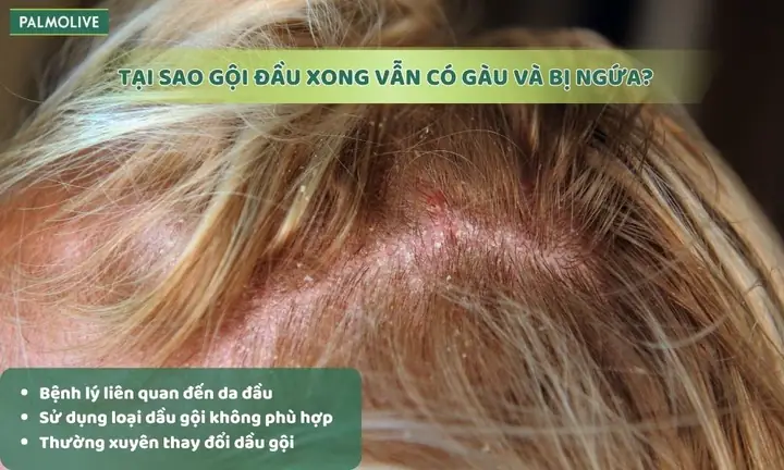 Vừa Gội Đầu Xong Da Có Gàu