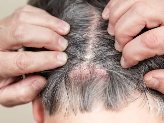 Vừa Gội Đầu Xong Da Có Gàu
