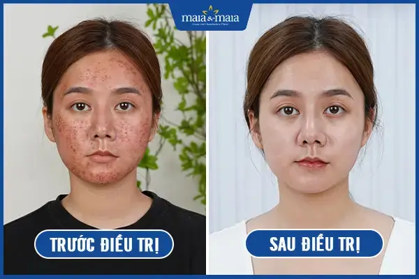 Xông Mặt Trị Mụn Trứng Cá